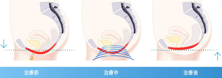 骨盤底筋における変化